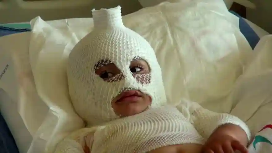 ERZURUM Kardeşinin devirdiği çaydanlıktaki kaynar su Eymen'in üzerine döküldü